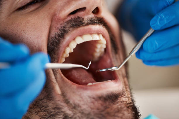 Best Emergency Treatment for Dental Infections or Abscesses in Temple City, CA
